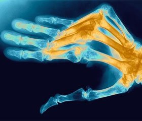 Artrita cu leziuni cutanate – probleme de diagnostic