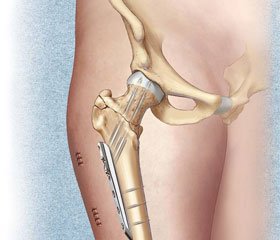 Внутрисуставные переломы шейки бедренной кости у пациентов в возрасте до 50 лет (особенности механогенеза и лечения)