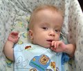 Первый опыт примененения памиреда при несовершенном остеогенезе у детей