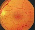 Динаміка поширеності та ризик розвитку діабетичної ретинопатії у хворих на цукровий діабет
