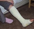 Профилактика и лечение дисрегенерации при диафизарных переломах верхних конечностей