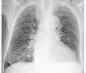 Occupational lung diseases: statistical indicators, risk assessment and biological markers