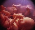 Зіставлення стану фетоплацентарного кровотоку та перебігу раннього неонатального періоду в новонароджених від багатоплідної вагітності