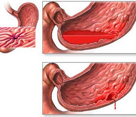 Гостра кровотеча при виразковій хворобі шлунку та дванадцятипалої кишки в до- та «хелікобактерний» періоди