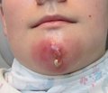 Indicators of System of Hemostasis in Children   of Early Age with Purulent Inflammatory Diseases of Maxillofacial Area combined with Anaemia