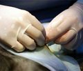 Рентгенэндоваскулярный гемостаз в комплексе хирургического лечения гастродуоденальных кровотечений язвенного генеза