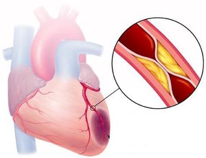 Нейрогуморальний вплив артеріальної гіпертензії на гострий інфаркт міокарда — патогенетичні взаємодії ремоделювання серця