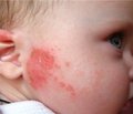 Атопічний дерматит у дітей