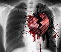 Догоспитальная тромболитическая терапия тенектеплазой у пациентов с инфарктом миокарда
