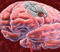 Острый ишемический инсульт: сравнительная эффективность цитиколинов