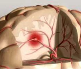 Олмесартан в лечении больных  ишемическим инсультом