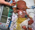 Анализ заболеваемости и смертности недоношенных новорожденных, имеющих дыхательные расстройства, в условиях крупного промышленного региона