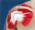 О нестабильности эндопротезов плечевого сустава у пациентов с застарелой травмой, осложненной повреждением нервных стволов