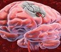 Применение ацетилсалициловой кислоты в низких дозах для первичной профилактики, неотложной терапии и вторичной профилактики ишемического инсульта