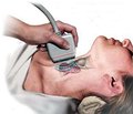 Прием селена приводит к снижению концентрации антител к тиреоидной пероксидазе у пациентов с аутоиммунным тиреоидитом