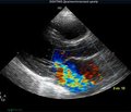 Возможности эхографии с использованием цветного допплеровского картирования в диагностике эндометриоидных кист