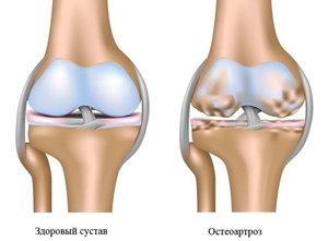 Фахова школа  «Остеоартроз гомілковостопного суглоба: сучасний стан проблеми»