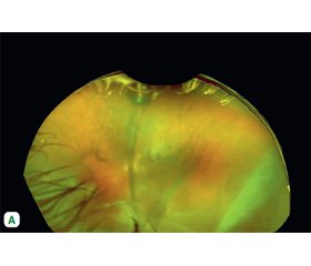 Перший випадок генонезалежної генетичної терапії пігментного ретиніту у пацієнта з української популяції