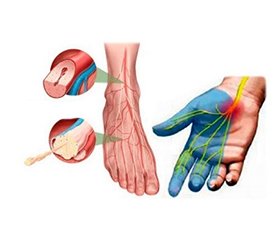 Хронічна запальна аксональна поліневропатія (клінічне спостереження, обговорення)