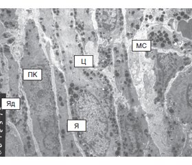 Ультраструктурні особливості меланоми хоріоідеї після комбінованої дії транспупілярної термотерапії та брахітерапії стронцієм-90/ітрієм-90 за розробленою методикою та віддаленні результати лікування
