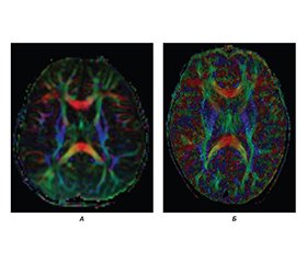 Оцінка ефективності комплексної терапії порушень мовленнєвого та когнітивного розвитку у дітей в умовах воєнного часу