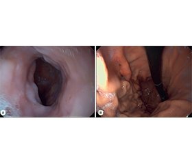 Складний клінічний випадок грижі стравохідного отвору діафрагми з синдромом Кемерона