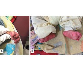 Вроджений сифіліс, пов’язаний із грудним вигодовуванням, у немовляти від серонегативної матері: клінічний випадок