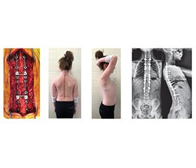 Хірургічна корекція вродженого кіфозу в пацієнтів з незавершеним кістковим ростом: клінічний випадок